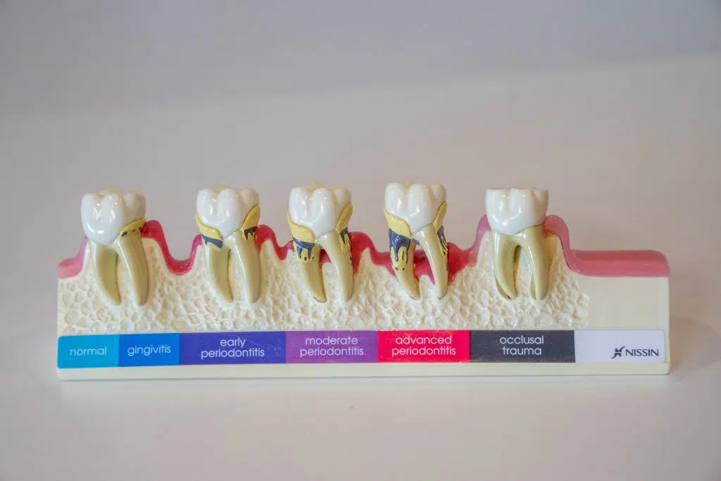 protect teeth
