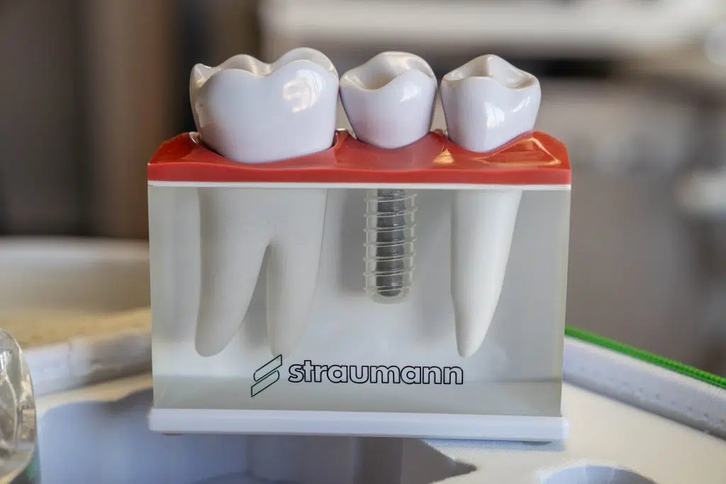 dental implants