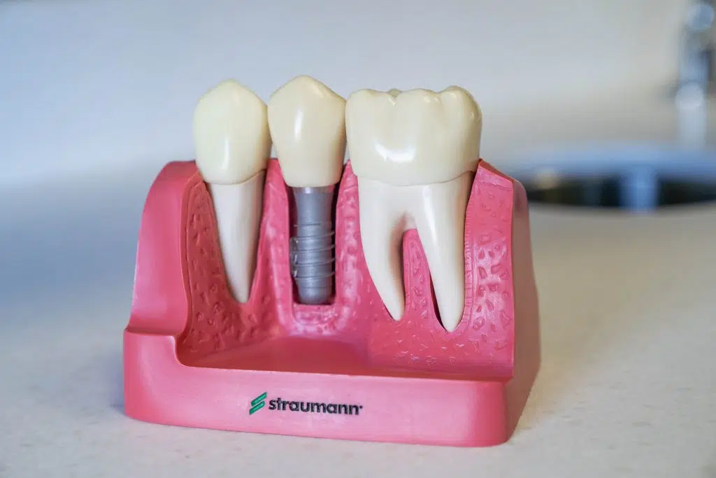 dental implants