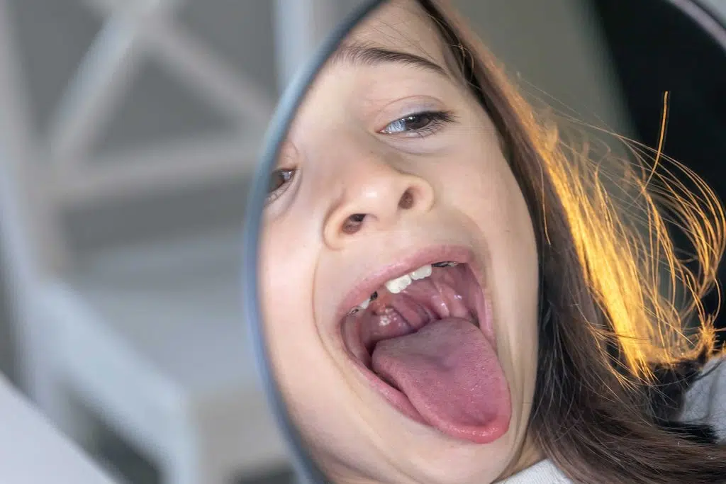 little girl showing bitten tongue