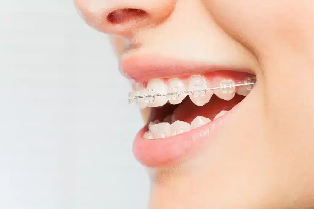 Invisalign or Braces? Key Differences & How to Decide