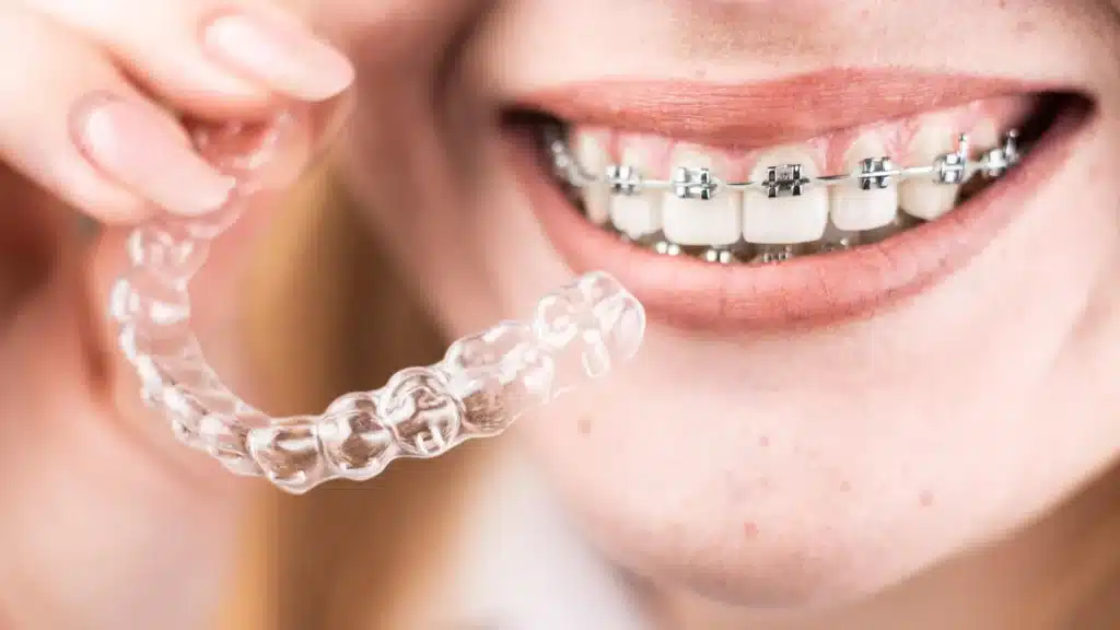 invisalign or braces