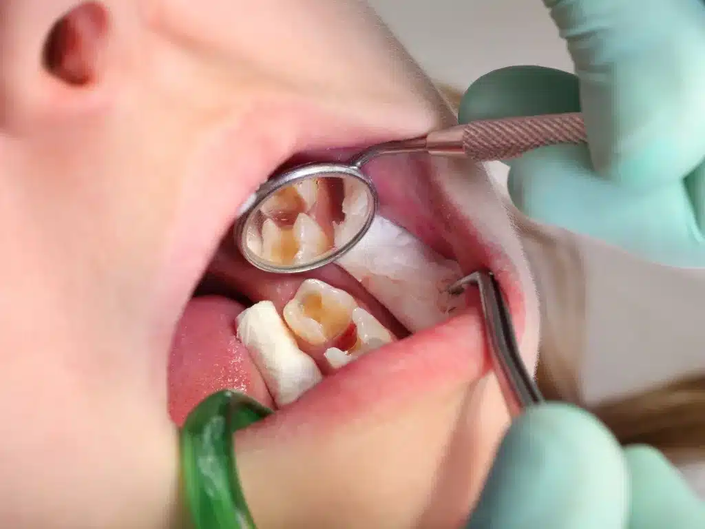 What Happens When a Cavity Has Formed