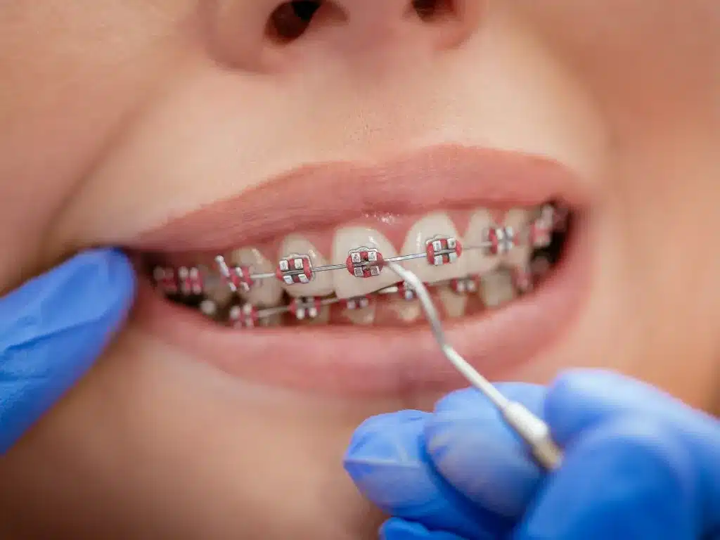 The Role of Private Dental Insurance for Braces